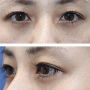 目の横幅を広げる目尻切開の効果とダウンタイム 失敗しないために知っておきたい基礎知識 Kirei 目の横幅を広げる目尻切開の効果とダウンタイム 失敗しないために知っておきたい基礎知識 Kirei