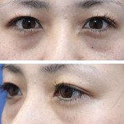 目の横幅を広げる目尻切開の効果とダウンタイム 失敗しないために知っておきたい基礎知識 Kirei 目の横幅を広げる目尻切開の効果とダウンタイム 失敗しないために知っておきたい基礎知識 Kirei