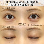 目の横幅を広げる目尻切開の効果とダウンタイム 失敗しないために知っておきたい基礎知識 Kirei 目の横幅を広げる目尻切開の効果とダウンタイム 失敗しないために知っておきたい基礎知識 Kirei