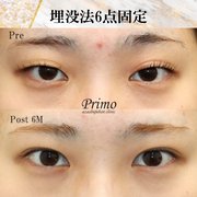 目の横幅を広げる目尻切開の効果とダウンタイム 失敗しないために知っておきたい基礎知識 Kirei 目の横幅を広げる目尻切開の効果とダウンタイム 失敗しないために知っておきたい基礎知識 Kirei
