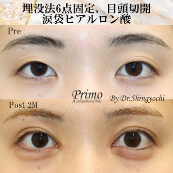 Shingyochi Yoshiaki 内管切口 眼部塑形 眼部塑形 双眼皮埋葬方法 眼部塑形 眼睛解剖的内眼角 透明质酸 透明质酸注射液 のbefore After Kirei Shingyochi Yoshiaki 内管切口 眼部塑形 眼部塑形 双眼皮埋葬方法 眼部塑形 眼睛解剖的内眼角 透明质酸 透明质酸注射液 のbefore After Kirei