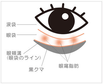 経結膜脱脂法による失敗したくない目の下のたるみ 黒クマ取り治療 Kirei