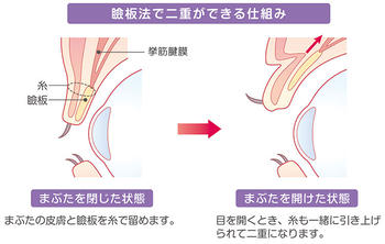 可以重做的双形埋葬方法的持久性 停机时间和术后病程 Kirei