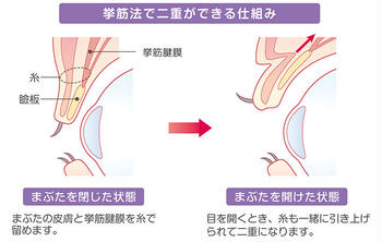 Persistence Of Double Plastic Surgery Burial That Can Be Redone Downtime And Postoperative Cours Kirei