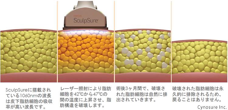 Scalpsure reduces fat cells, so there is less rebound_Scalpsure reduces the thickness of subcutaneous fat