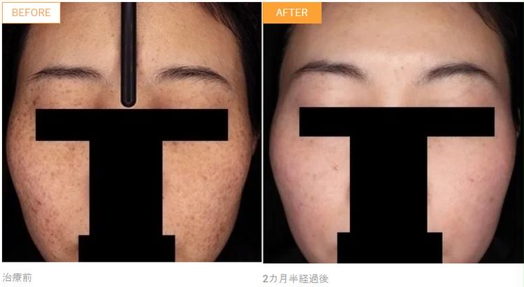Фото случая Zeo Skin Health (до и после)