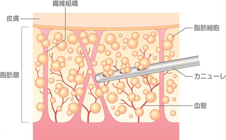 Illustration de l'élimination de la graisse par canule
