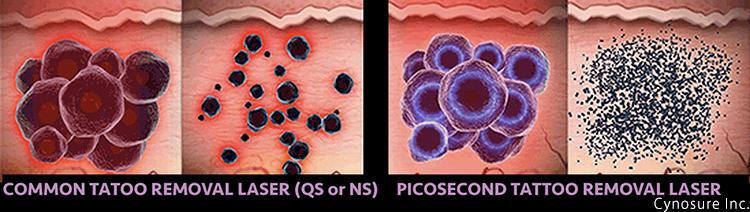 Pico-Spot für Hautunreinheiten und Sommersprossen_Cynosure