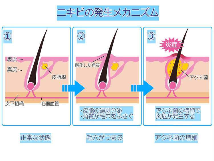 Mechanism of acne