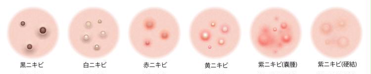 Types d'acné