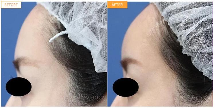 Inject hyaluronic acid to round the forehead (forehead) Injection amount and price Market / duration