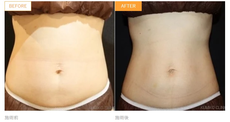 Cool Sculpting Case Photo (Before After) Abdomen