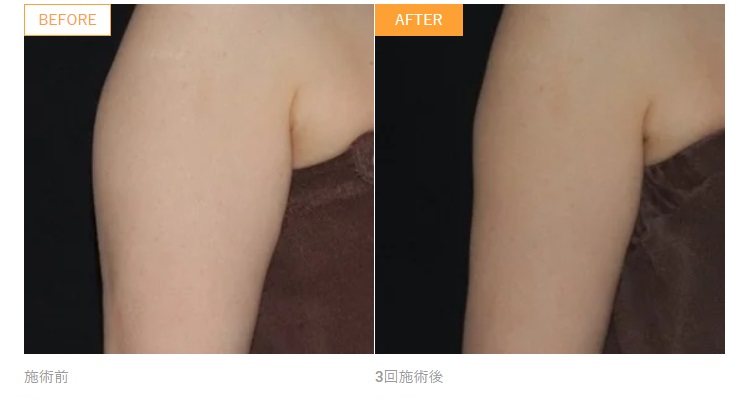 Cool Sculpting Case Photo (Before After) Bovenarm