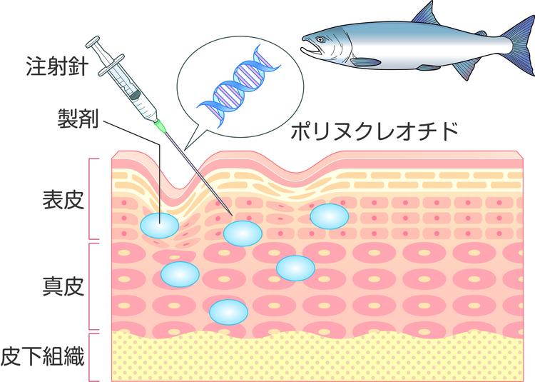 การฉีด Rejuran โดยมี DNA ที่ได้จากปลาแซลมอนเป็นส่วนประกอบหลัก