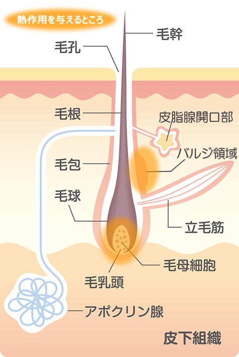 头发结构示意图和蓄热型脱毛的作用