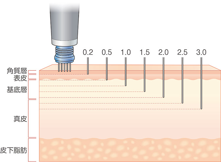 Ajuste a profundidade da agulha em incrementos de 0,1 mm