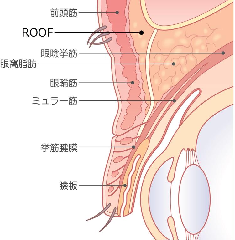 Áreas alrededor de los párpados relacionadas con el método de incisión.