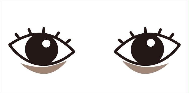 Bear due to pigmentation of the lower eyelid