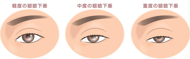 下眼瞼形成では眼瞼下垂の改善はできない