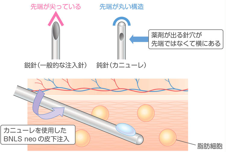 BNLS neo injection method illustration using a cannula