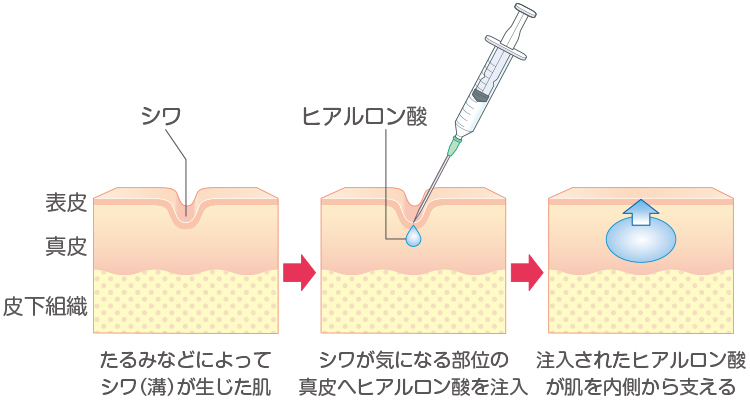 Immagine del trattamento delle rughe mediante iniezione di acido ialuronico