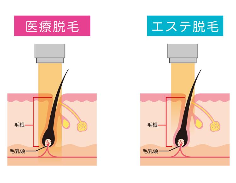 Difference between medical hair removal and esthetic hair removal