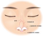 Treatment of stair nose (eagle nose) by injecting hyaluronic acid