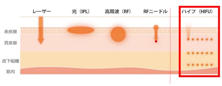 Een diagram met de energy_skin-diepte van Ultraformer 3 genaamd HIFU